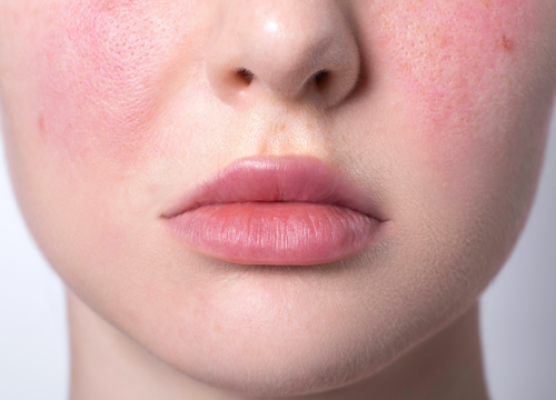 Soins anti-rougeurs